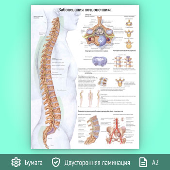Плакат «Заболевания позвоночника» (ЗОЖ-43, 1 лист, А2)
